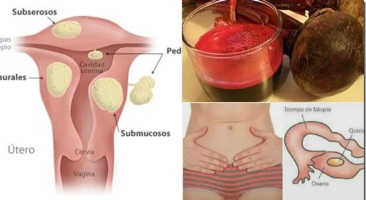 Un efectivo remedio para combatir miomas uterinos 
