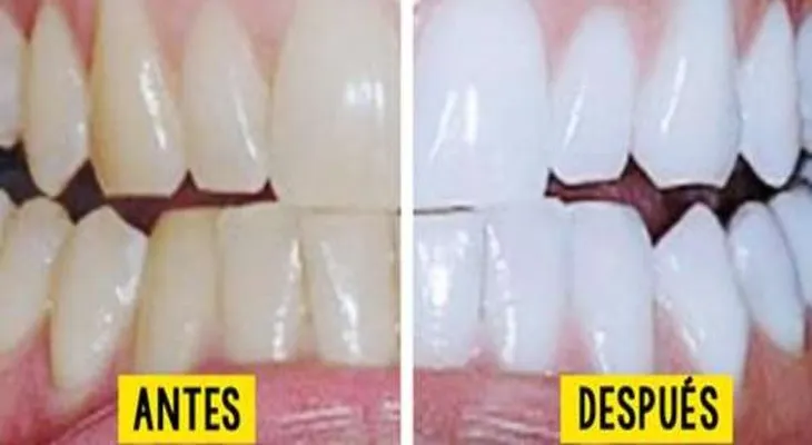 3 ingredientes mezclado y luego colocado en sus dientes...No podrás creer los resultados 