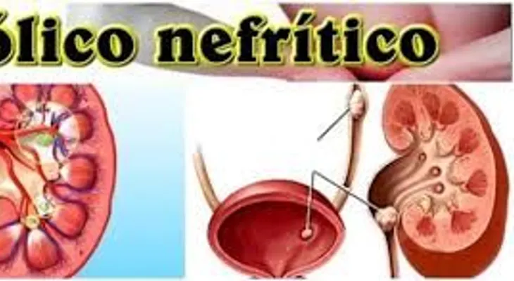Cólico nefrítico: síntomas, causas y tratamiento