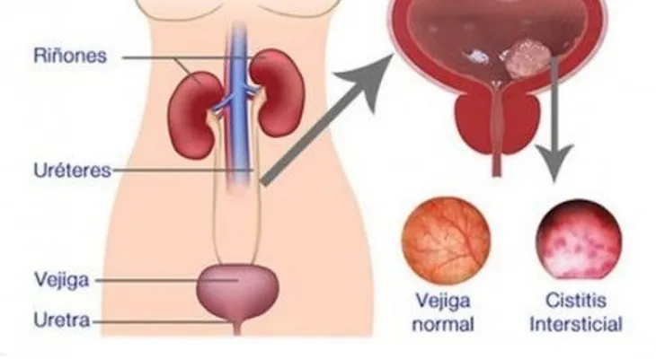 Cambios en tus hábitos para prevenir la cistitis