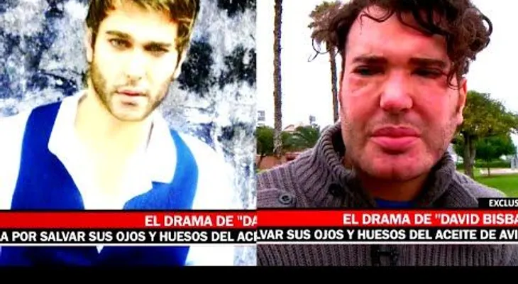 Quería parecerse a David Bisbal y le inyectaron aceite de avión (VIDEO)