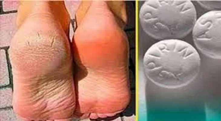 Mezcla 10 aspirinas trituradas con alcohol, y los talones agrietados, callos y venas varicosas desaparecerán 