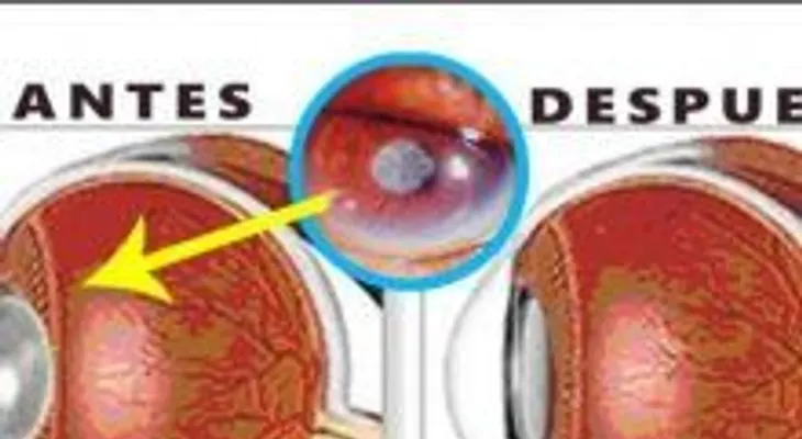 Recupera tu visión casi al 100% y tira tus lentes al zafacón con este remedio