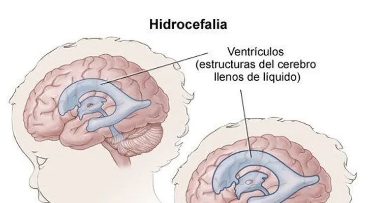  Cirugía endoscópica es una opción para tratar eficazmente la hidrocefalia 
