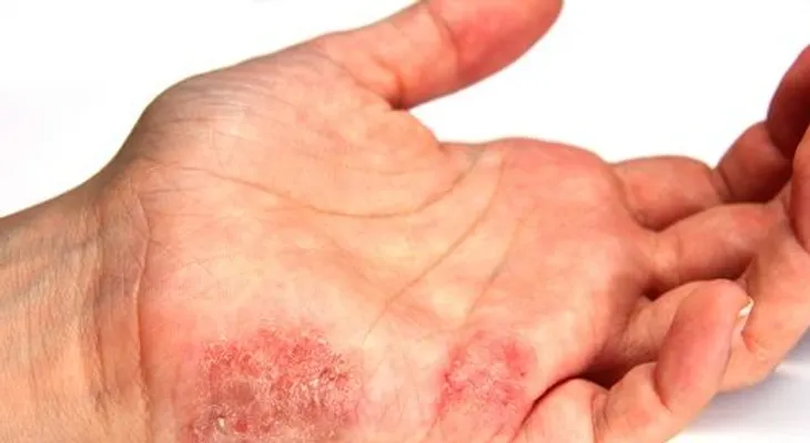 5 remedios caseros para la psoriasis