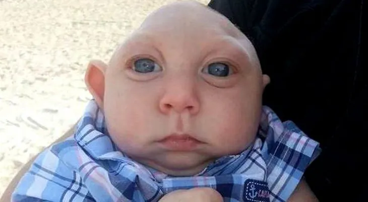 Niños que nacen sin cerebro: La anencefalia (VIDEO)