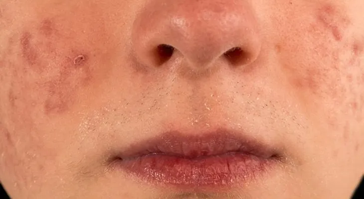 Aclara las marcas del acné con estos 4 remedios naturales