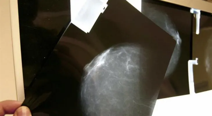 Mujeres sedentarias tienen 71 por ciento más de riesgo de cáncer de mama