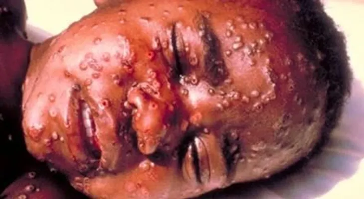 Alerta ante posibles casos de Ebola en Republica Dominicana