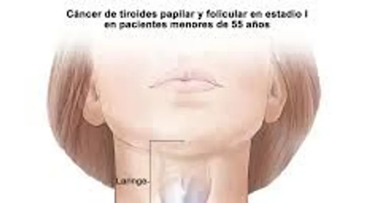 Síntomas "inofensivos", de un posible cáncer de tiroides. ¡No los dejes pasar!