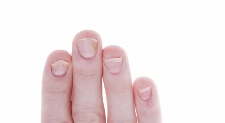 Manifestaciones en las uñas pueden dar indicio de la artritis psoriática