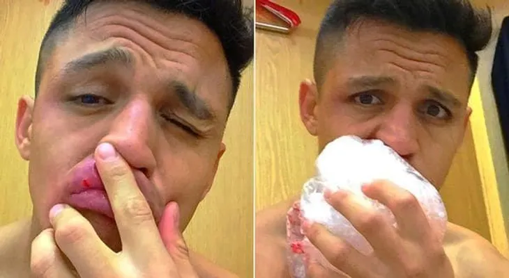 IMAGENES FUERTES: La espeluznante comparación de un ex rugbier para burlarse del golpe que sufrió Alexis Sánchez