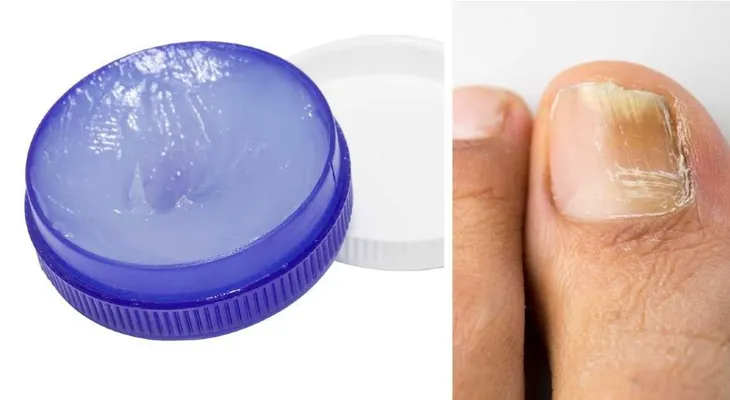 Lo que nadie te había dicho de este ungüento increíble. Antes y después. ¿Quieres Saber más?, sigue leyendo?