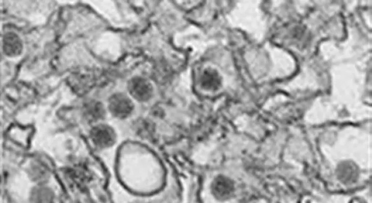 Mujer argentina con zika tras posible contagio sexual