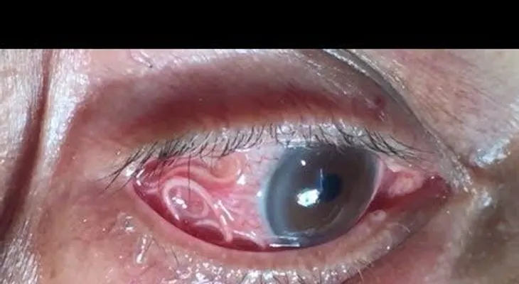 Le dolía mucho un ojo, fue al médico y le sacaron algo horrible 