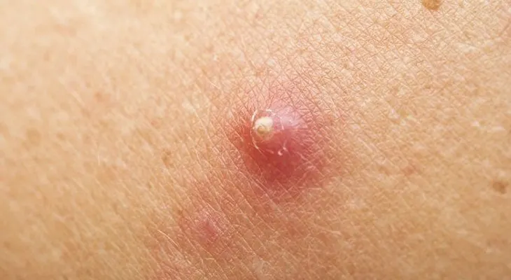 Tratamiento natural para los abscesos