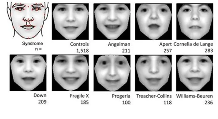 Crean un software capaz de diagnosticar trastornos genéticos por una foto
