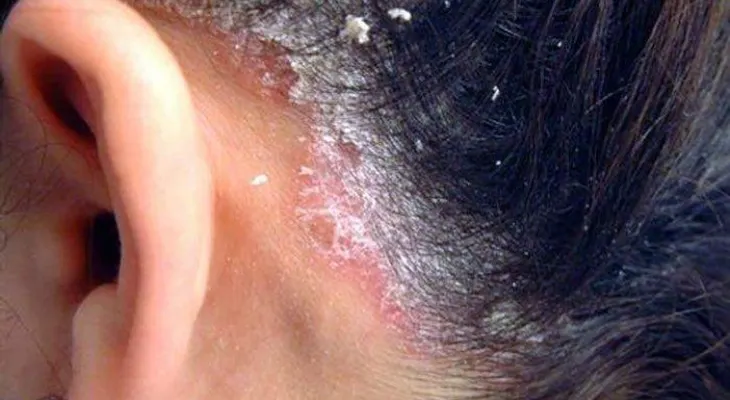 Psoriasis: 8 cosas que no sabías sobre esta enfermedad