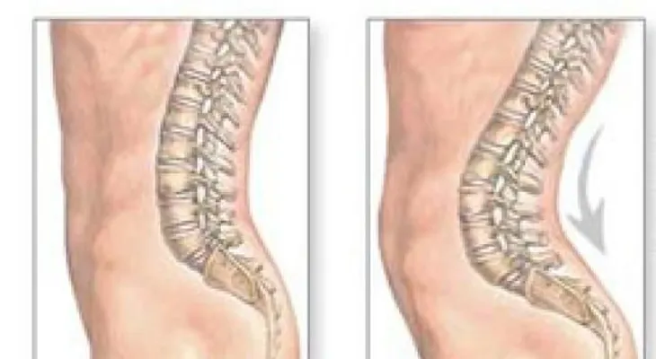  ¿Cuáles son las causas de la hiperlordosis?. Otros síntomas relacionados incluyen: