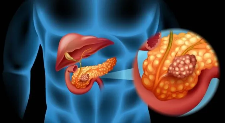 Presentan en México medicamento que ayuda en la lucha contra cáncer de páncreas 