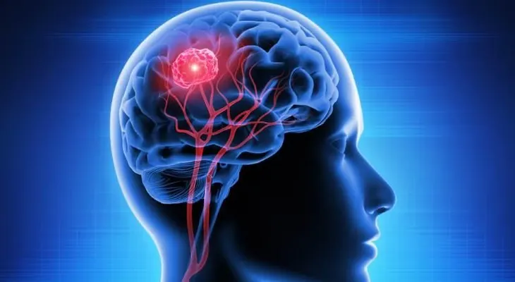 Dra García revela que los tumores cerebrales tienen una sobrevida a 5 años de 33.2 %