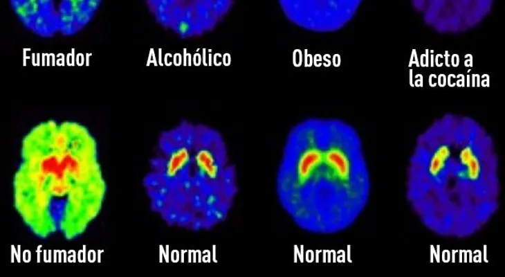 ¿Qué hace el azúcar con nuestro cerebro?