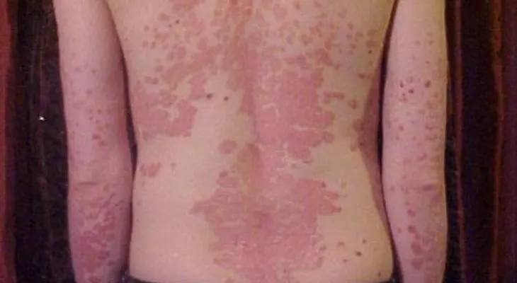 Psoriasis: Una enfermedad muy grave; imágenes de personas afectadas 