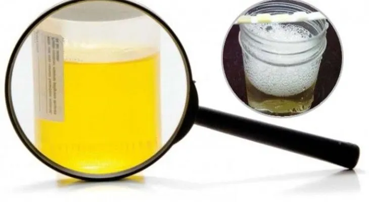 Si tu orina hace espuma, podría causarte una insuficiencia renal