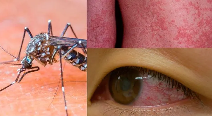 11.700 contagiados del virus zika en Colombia