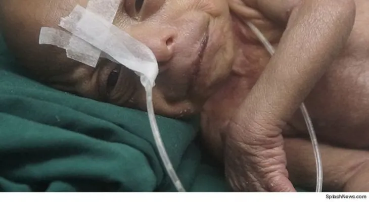 Nace un "bebé anciano" en Bangladesh, que rememora a Benjamín Button en vida real