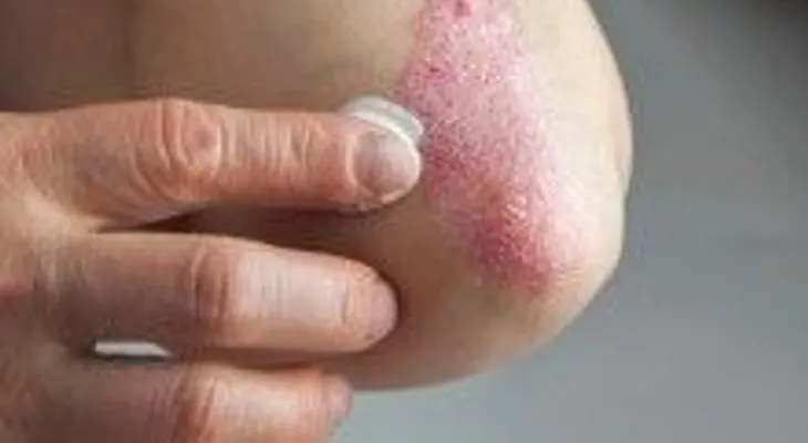 Increíble arma secreta para eliminar la psoriasis !!! 