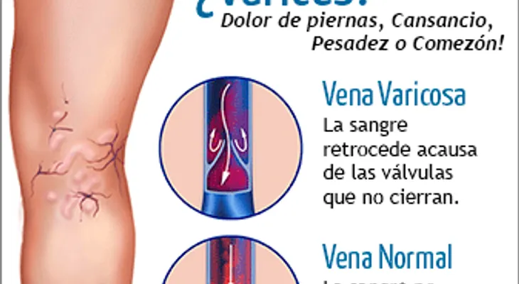Usé este remedio y las várices empezaron a borrarse el mismo día