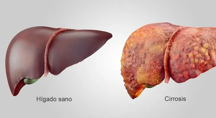 9 remedios caseros para la cirrosis hepática