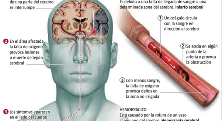 Accidente cerebrovascular isquémico