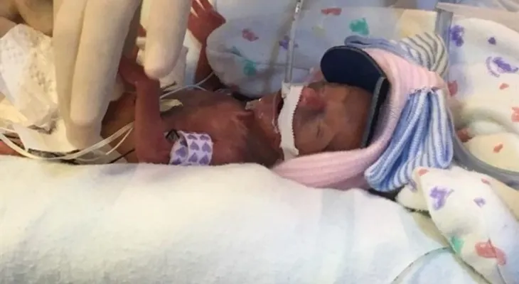 Niña que pesó al nacer 368 gramos recibe el alta después de cuatro meses
