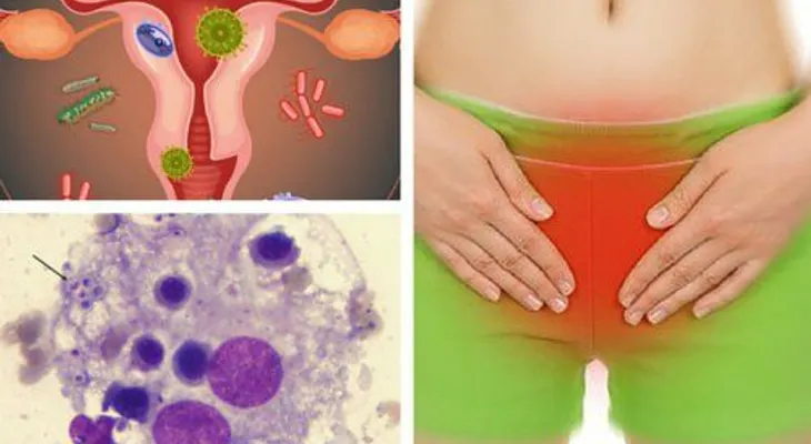 Con esto SI puede eliminar hongos vaginales, bacterias y mal olor, pero el ginecólogo nunca te lo dirá