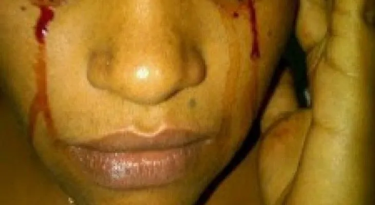 Rara enfermedad provoca que joven brote sangre por sus ojos