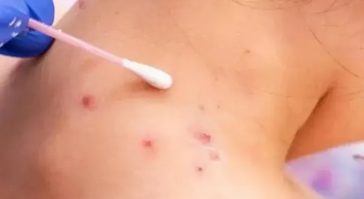 Haití emite alerta por presencia de viruela del mono en territorio dominicano