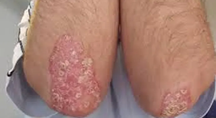La psoriasis afecta la calidad de vida de quienes la padecen