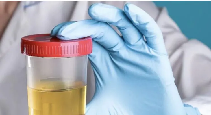 Simple prueba de orina detecta cáncer de próstata