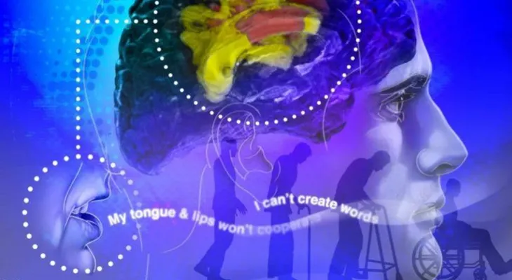 ¡Mosca! La apraxia puede avanzar a enfermedad neurodegenerativa