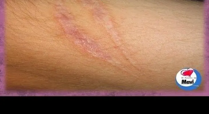 !Atención Mujeres! : La manera fácil de eliminar cicatrices y estrías (VIDEO)