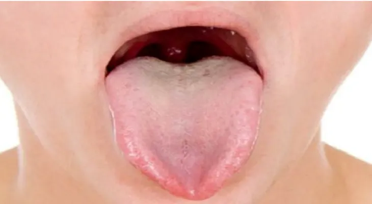 Descubre tu enfermedad según el color de la lengua 