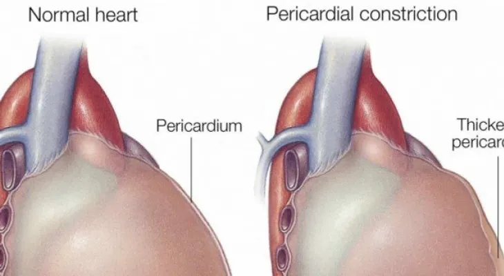 La constricción pericárdica puede afectar considerablemente a los riñones