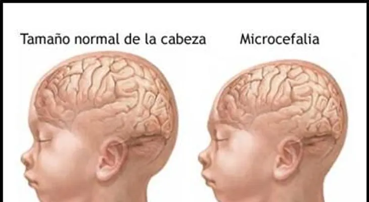 Nace bebé con anomalías congénitas, incluso microcefalia