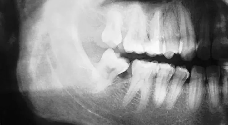 Crean una mandíbula con impresora 3D y la implantan a un niño de 10 años, en China