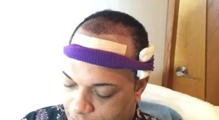 Jary Ramírez se somete a trasplante de pelo