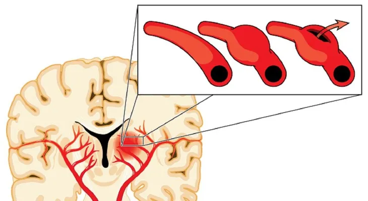 Una mujer sufrió un derrame cerebral durante la relación