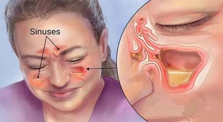 Elimina la infección de la sinus en pocos segundos con este método simple y común de la casa