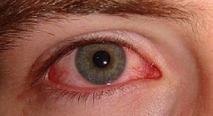 Conjuntivitis se ha convertido en viral y tiene preocupado a la población